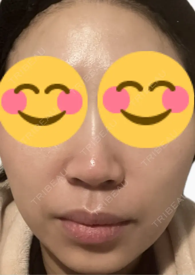 脂肪溶解注射（顔） 吉祥寺アイビークリニック DAY 7 メイン用