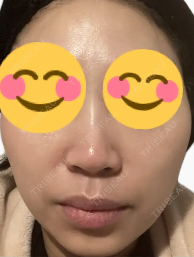 ルメッカ 東京シルククリニック 新宿院 DAY 3 メイン用