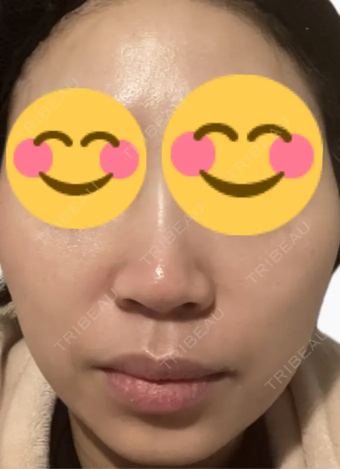 肌育注射（ジュベルックなど） 美容皮膚科エルムクリニック 麻布院 DAY 1 メイン用