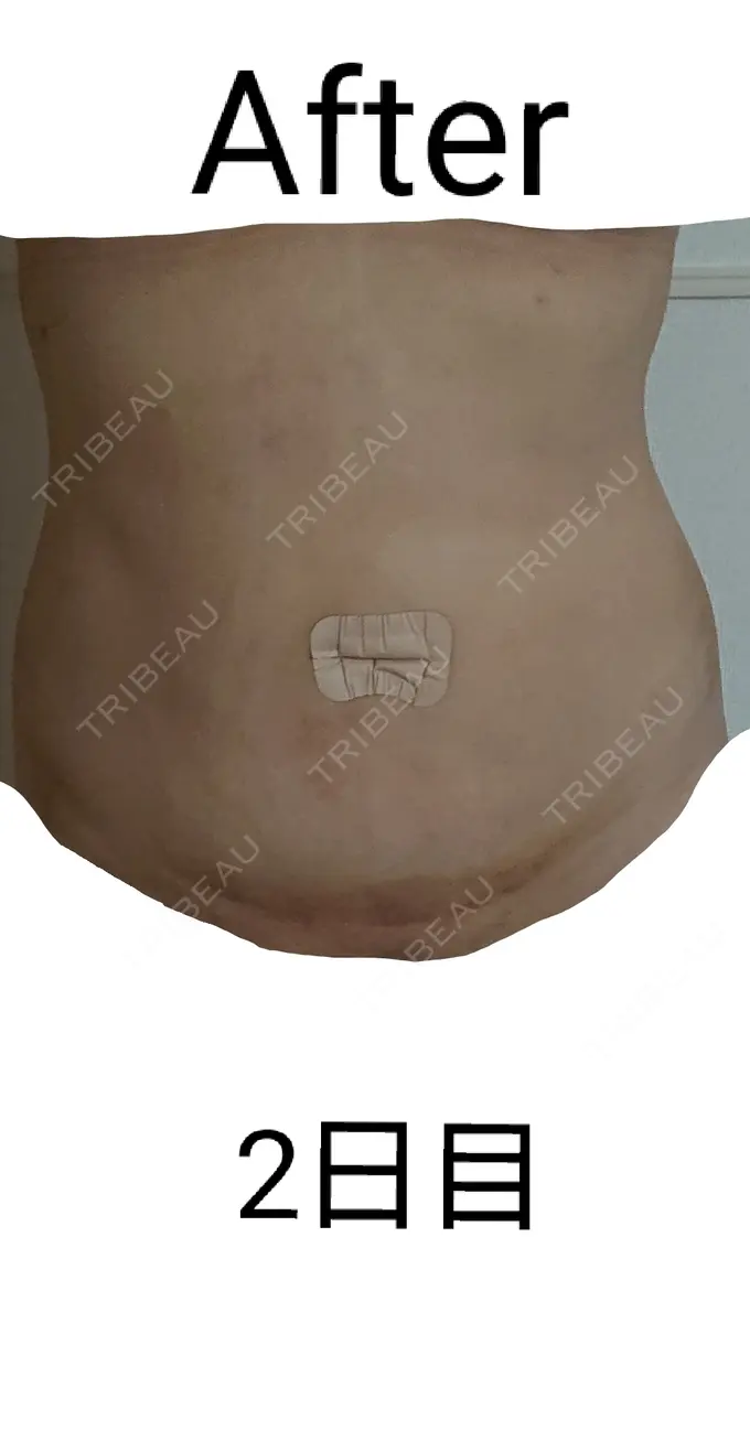 脂肪吸引（お腹） 城本クリニック 岡山院 DAY 2 メイン用