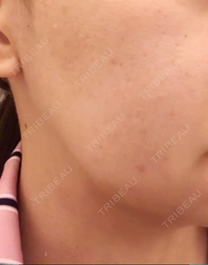 フォトRF 東京美容外科 梅田院 DAY 3 メイン用