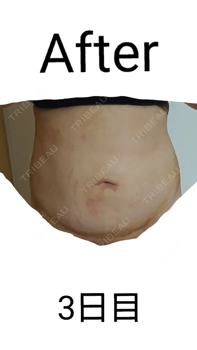 脂肪吸引（お腹） 城本クリニック 岡山院 DAY 3 メイン用