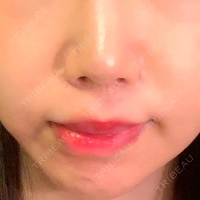 人中短縮 東京皮膚科・形成外科 (銀座いけだクリニック) DAY 21 メイン用