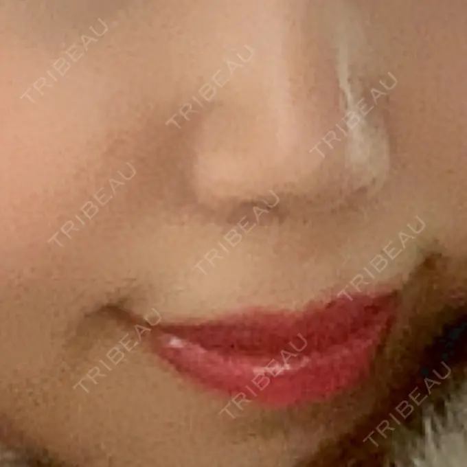 人中短縮 東京皮膚科・形成外科 (銀座いけだクリニック) DAY 24 メイン用