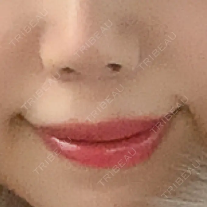 人中短縮 東京皮膚科・形成外科 (銀座いけだクリニック) DAY 24 メイン用