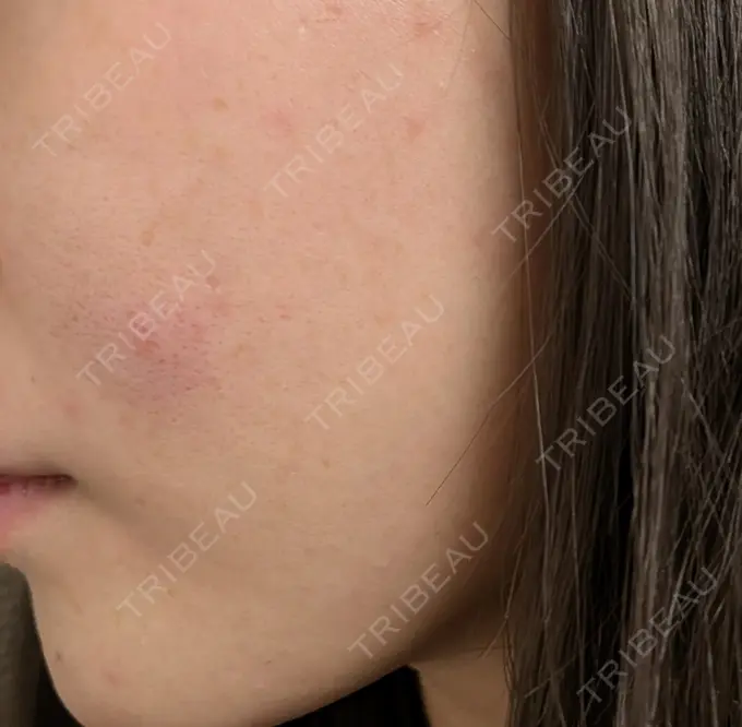 ニードルRF（ポテンツァなど） / ニキビ治療 KM新宿クリニック AFTER メイン用