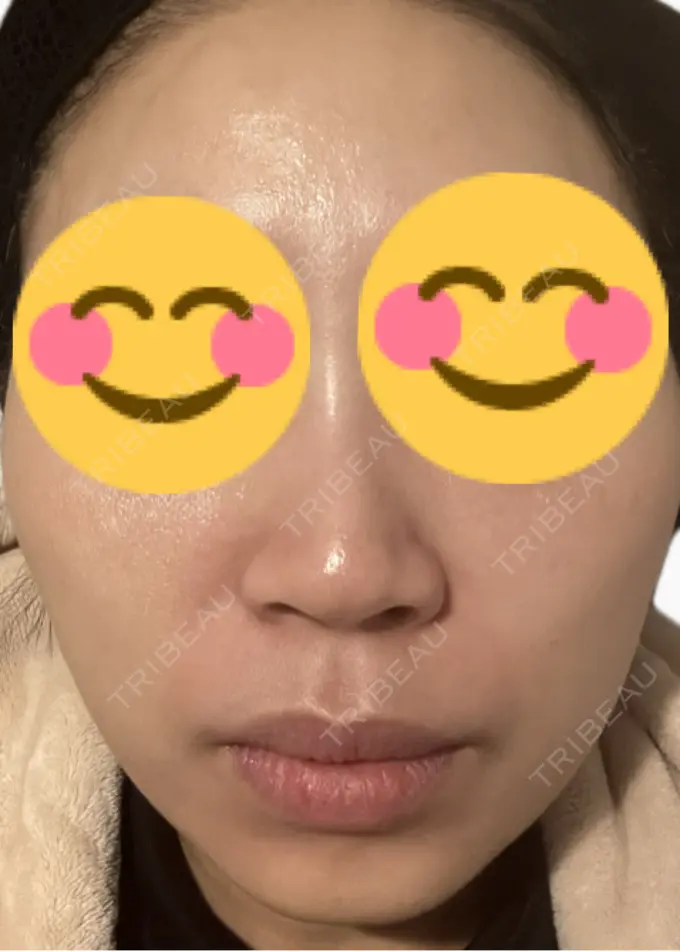 脂肪溶解注射（顔） 吉祥寺アイビークリニック DAY 8 メイン用