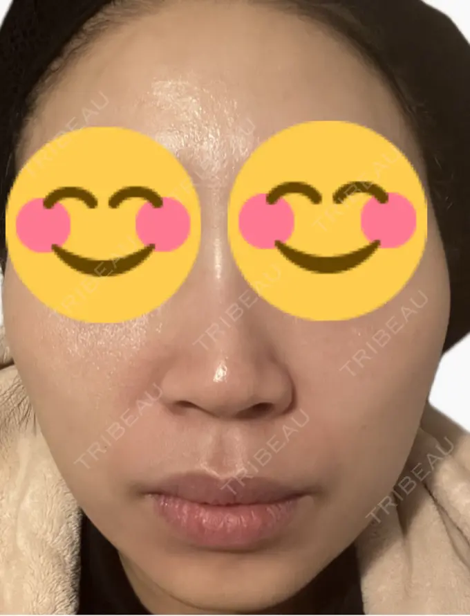 ルメッカ 東京シルククリニック 新宿院 DAY 4 メイン用