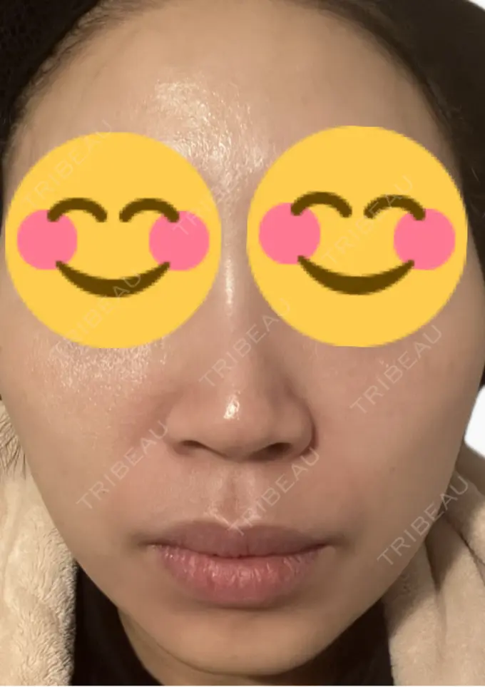 肌育注射（ジュベルックなど） 美容皮膚科エルムクリニック 麻布院 DAY 2 メイン用