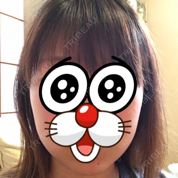 脂肪吸引（顔） みずほクリニック DAY 33 メイン用