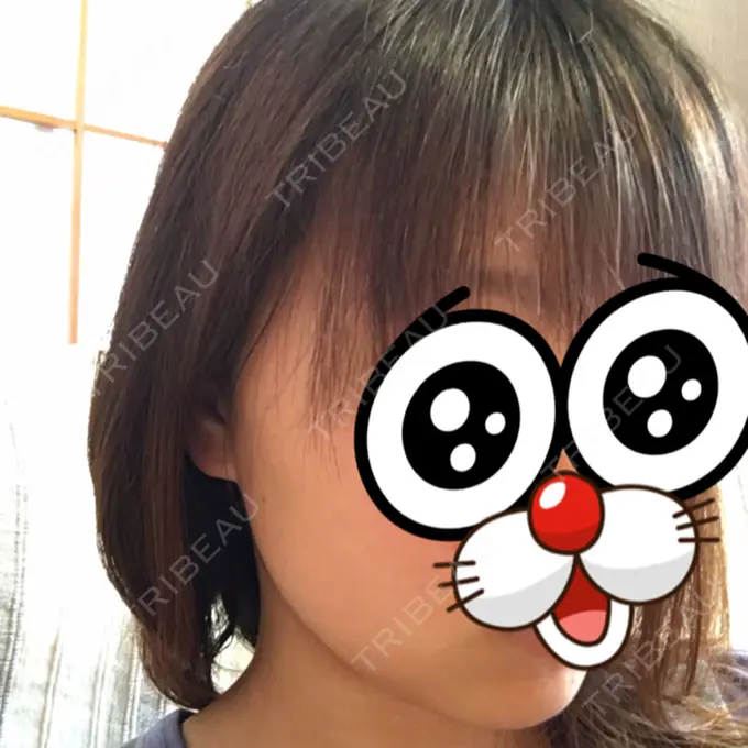 脂肪吸引（顔） みずほクリニック DAY 33 メイン用