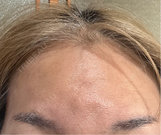 ボトックス（額） 小倉美容外科ネビュラクリニック DAY 9 メイン用