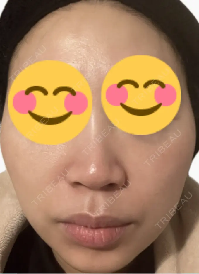 脂肪溶解注射（顔） 吉祥寺アイビークリニック AFTER メイン用