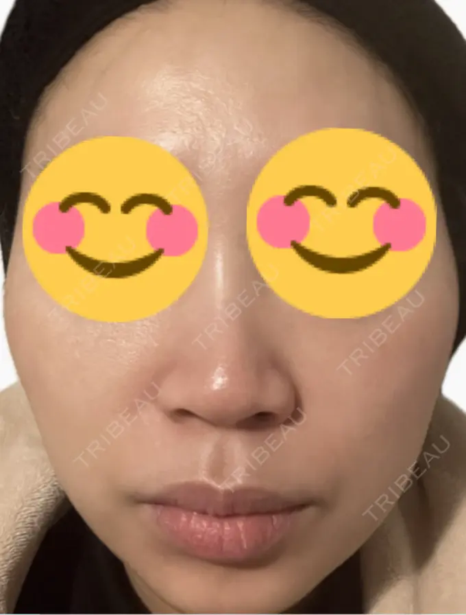 ルメッカ 東京シルククリニック 新宿院 DAY 5 メイン用