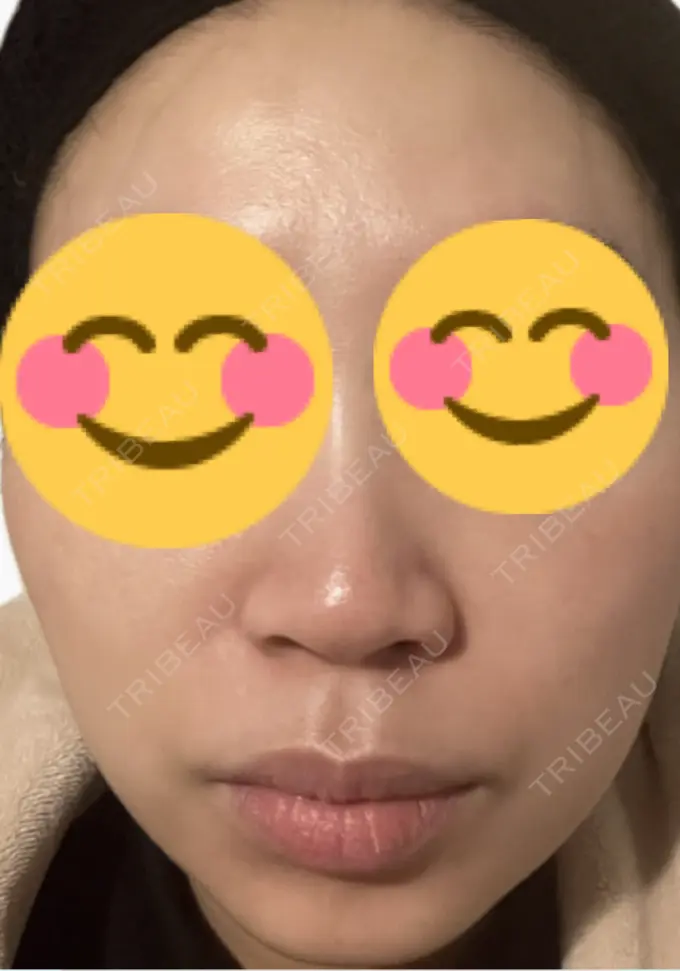 ルメッカ 東京シルククリニック 新宿院 DAY 5 メイン用