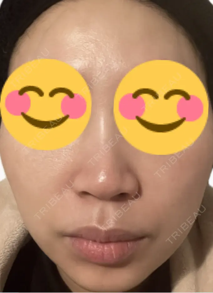 肌育注射（ジュベルックなど） 美容皮膚科エルムクリニック 麻布院 DAY 3 メイン用