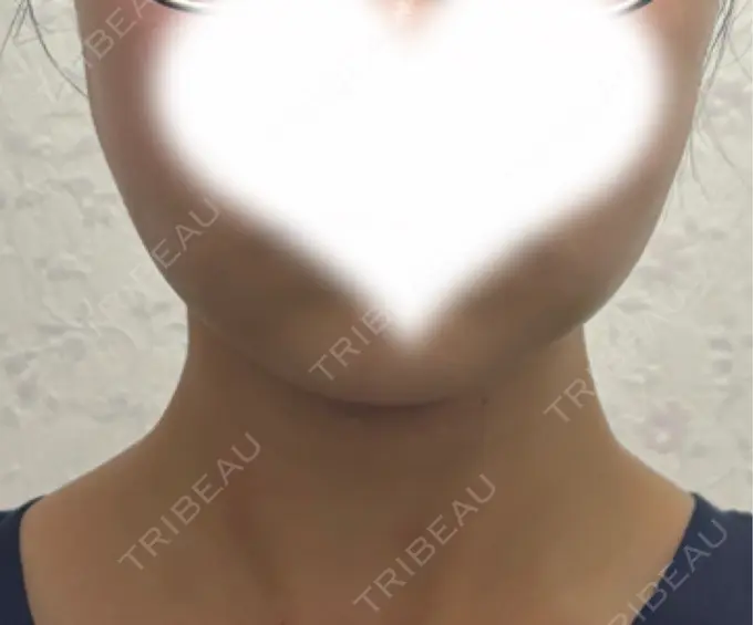 糸リフト / 脂肪吸引（顔） / ジョールファット除去 アリエル美容クリニック 水戸院 DAY 14 メイン用