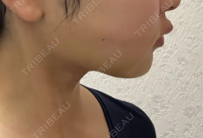 糸リフト / 脂肪吸引（顔） / ジョールファット除去 アリエル美容クリニック 水戸院 DAY 14 メイン用