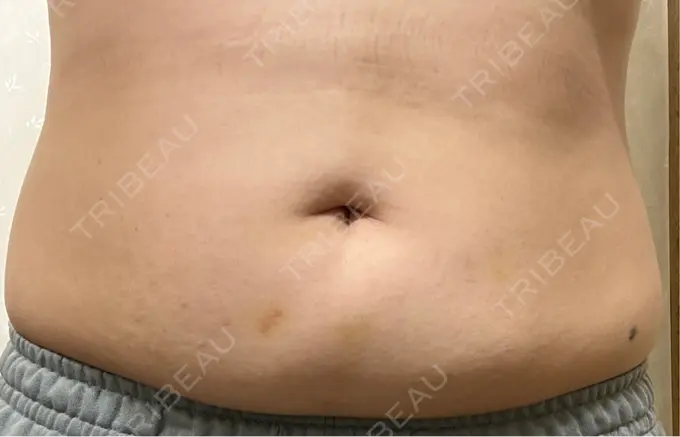 脂肪溶解注射（お腹） FIG CLINIC AFTER メイン用