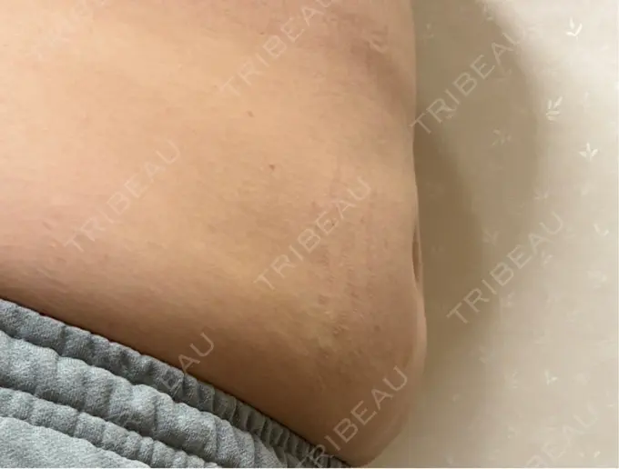 脂肪溶解注射（お腹） FIG CLINIC DAY 15 メイン用