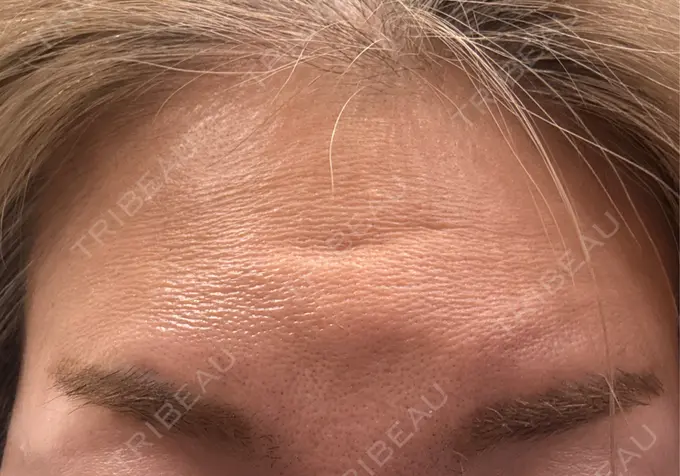 ボトックス（額） 小倉美容外科ネビュラクリニック DAY 10 メイン用