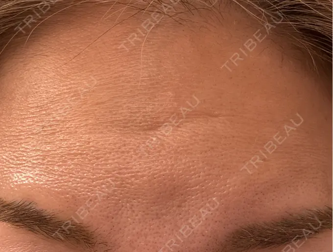 ボトックス（額） 小倉美容外科ネビュラクリニック DAY 10 メイン用