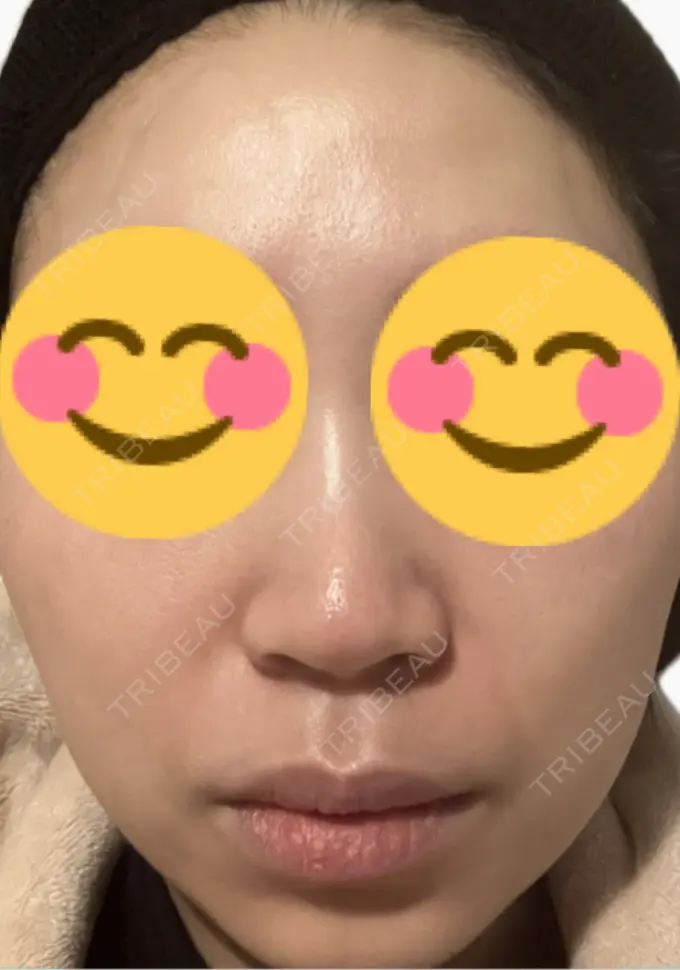 肌育注射（ジュベルックなど） 美容皮膚科エルムクリニック 麻布院 DAY 4 メイン用