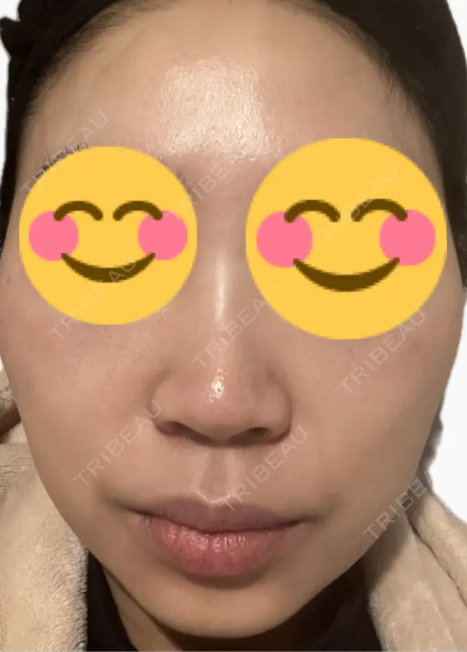 ルメッカ 東京シルククリニック 新宿院 DAY 7 メイン用