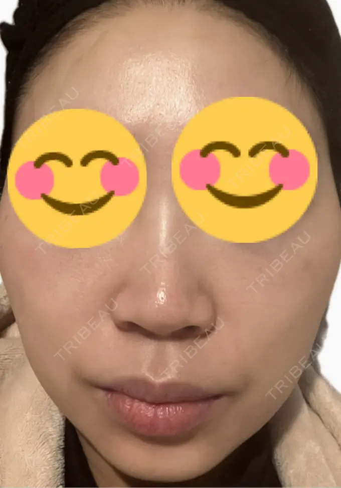 肌育注射（ジュベルックなど） 美容皮膚科エルムクリニック 麻布院 DAY 5 メイン用