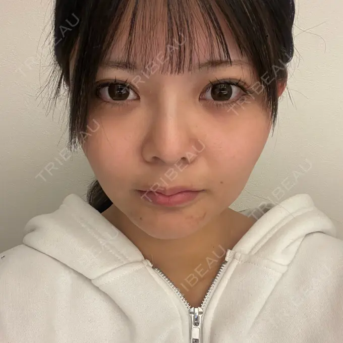 糸リフト / あご下筋肉縛り WOM CLINIC GINZA （ワム クリニック ギンザ） DAY 10 メイン用