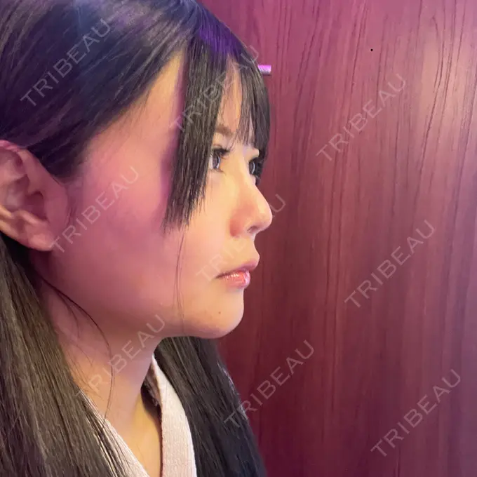 糸リフト / あご下筋肉縛り WOM CLINIC GINZA （ワム クリニック ギンザ） DAY 10 メイン用