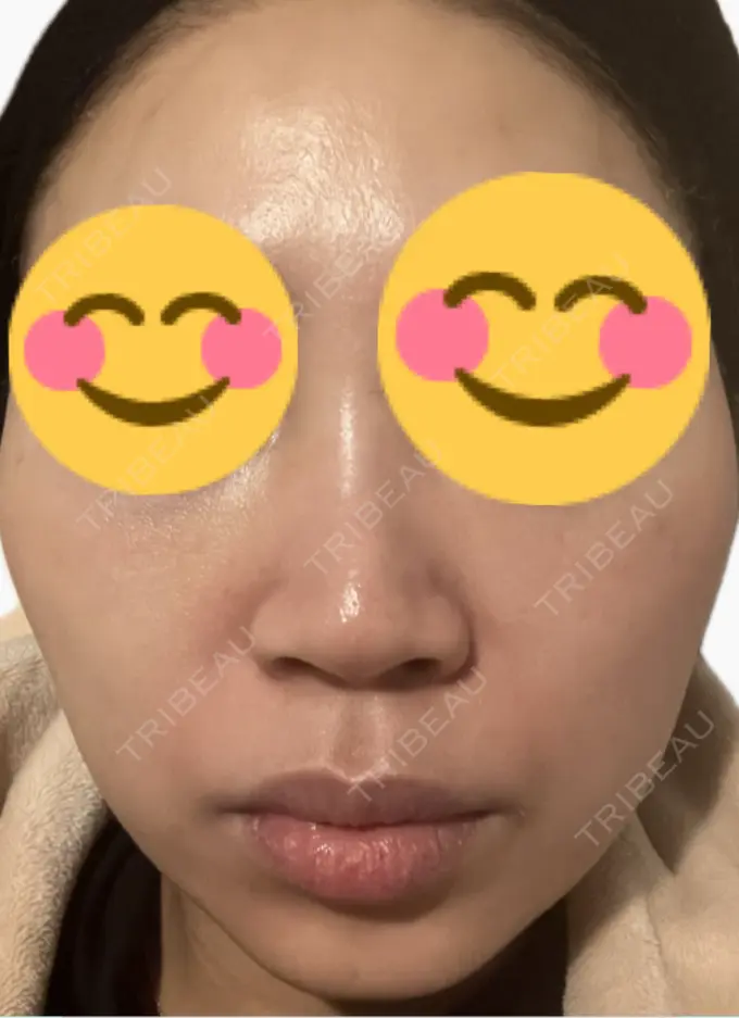 ルメッカ 東京シルククリニック 新宿院 AFTER メイン用