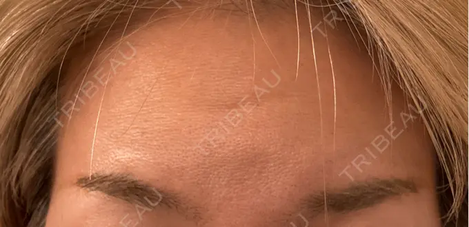 ボトックス（額） 小倉美容外科ネビュラクリニック DAY 13 メイン用