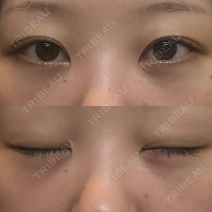 クマ治療 / 脂肪注入（目の下） 湘南美容クリニック 千葉センシティ院 DAY 21 メイン用