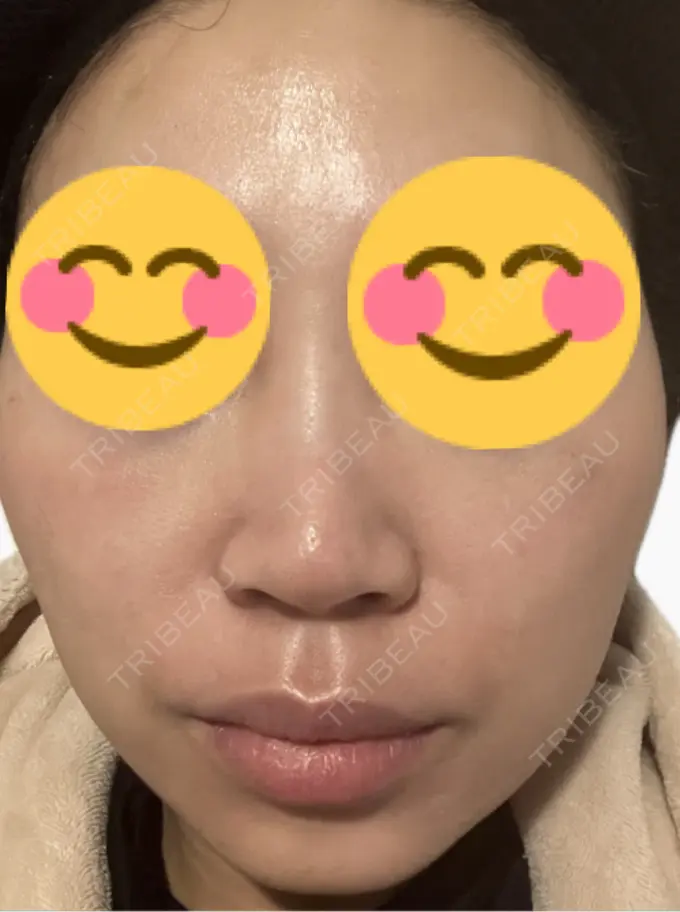 肌育注射（ジュベルックなど） 美容皮膚科エルムクリニック 麻布院 DAY 7 メイン用