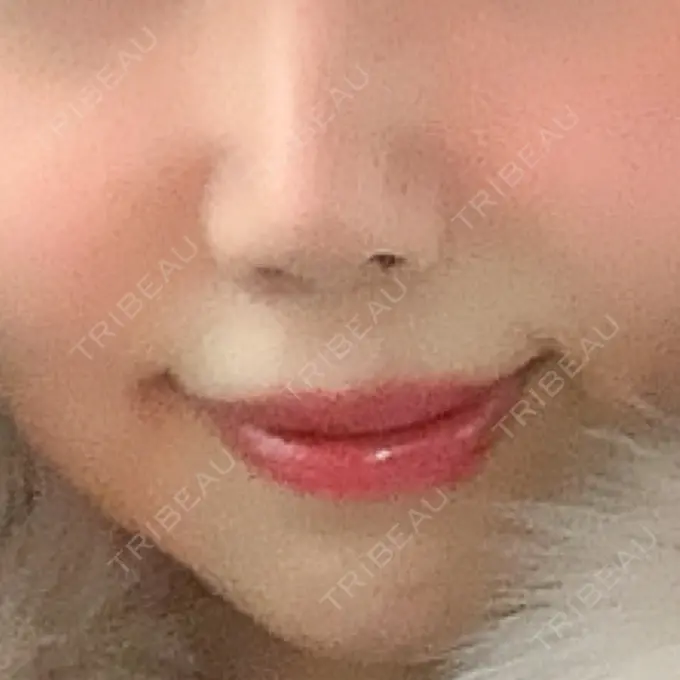 人中短縮 東京皮膚科・形成外科 (銀座いけだクリニック) DAY 24 メイン用