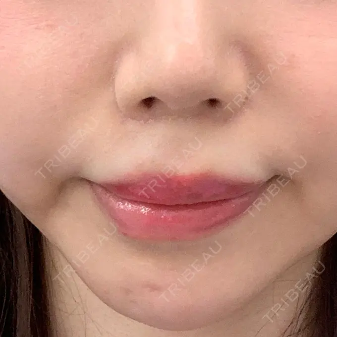 人中短縮 東京皮膚科・形成外科 (銀座いけだクリニック) DAY 21 メイン用