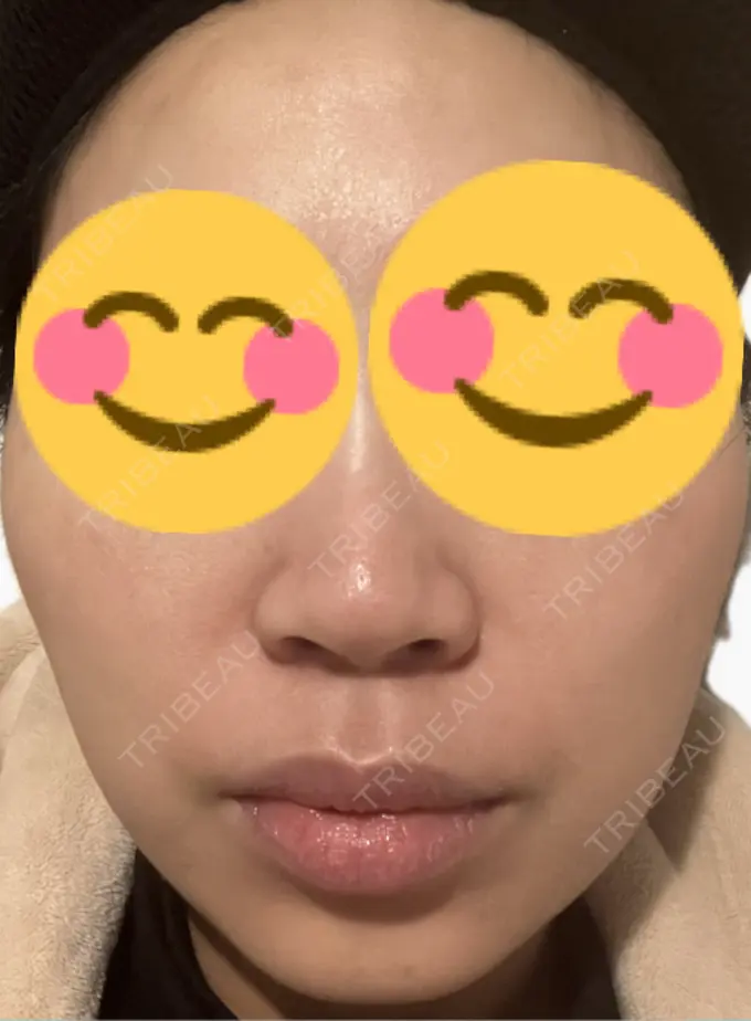 肌育注射（ジュベルックなど） 美容皮膚科エルムクリニック 麻布院 DAY 8 メイン用