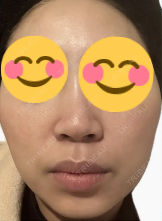 肌育注射（ジュベルックなど） 美容皮膚科エルムクリニック 麻布院 AFTER メイン用