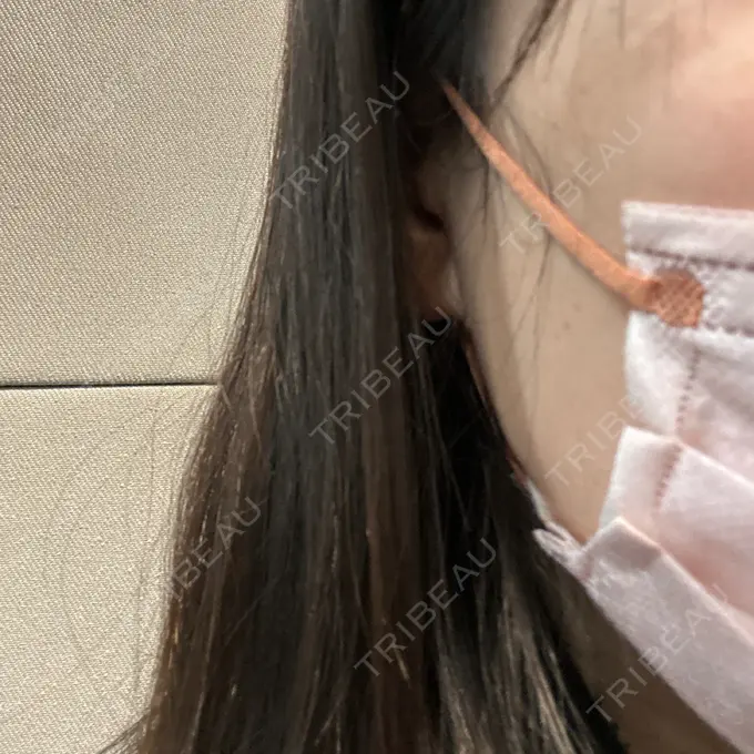 シミ取りレーザー さっぽろ美容クリニック AFTER メイン用