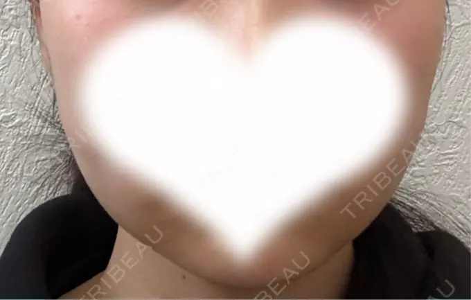 糸リフト / 脂肪吸引（顔） / ジョールファット除去 アリエル美容クリニック 水戸院 AFTER メイン用