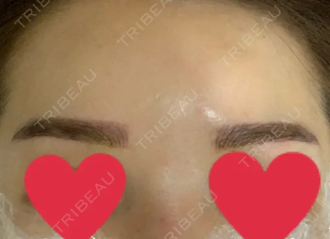 アートメイク（眉） QT整形外科(アートメイクセンター) DAY 1 メイン用