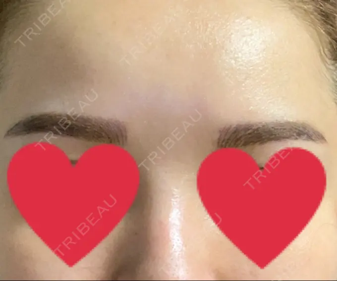 アートメイク（眉） QT整形外科(アートメイクセンター) DAY 2 メイン用