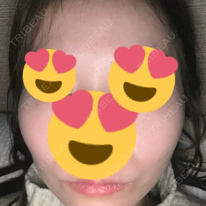 ほくろ・いぼ除去レーザー（肌） 共立美容外科 名古屋院 AFTER メイン用