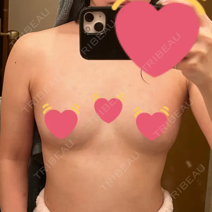 豊胸（脂肪注入） ルラ美容クリニック 大阪本院 AFTER メイン用