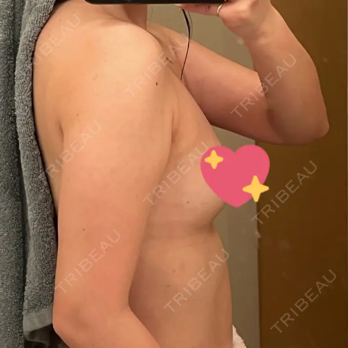 豊胸（脂肪注入） ルラ美容クリニック 大阪本院 DAY 39 メイン用