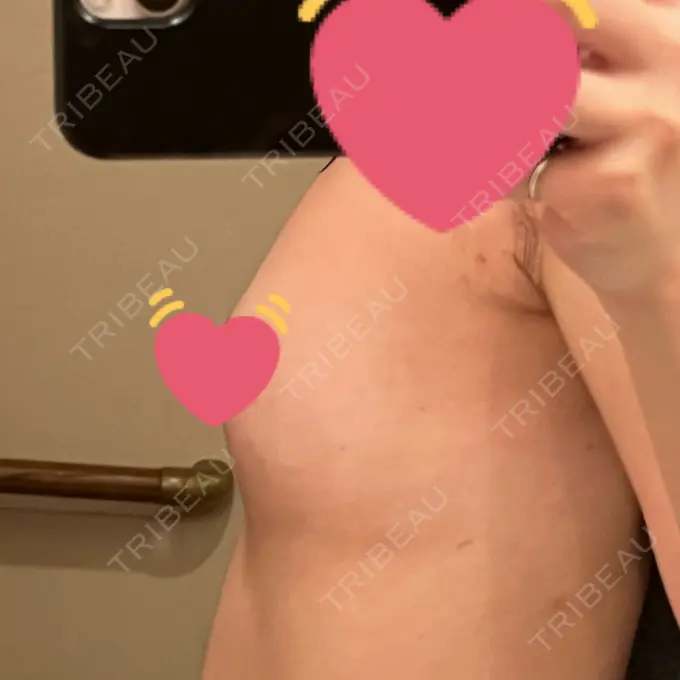 豊胸（脂肪注入） ルラ美容クリニック 大阪本院 DAY 39 メイン用