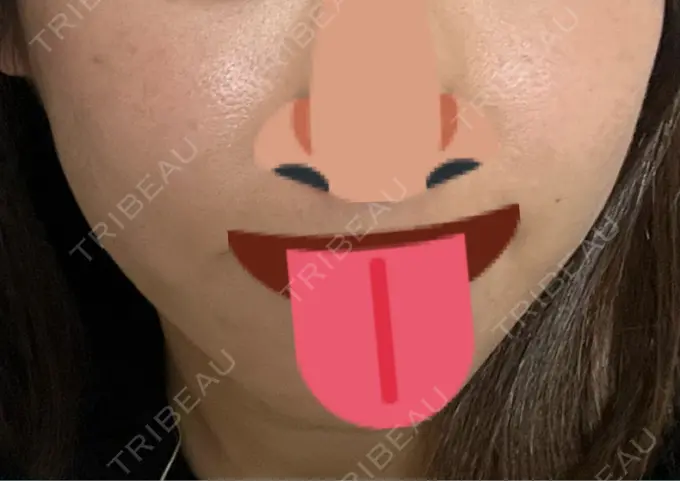 インモード 東京美容皮膚科アロエクリニック池袋 DAY 16 メイン用