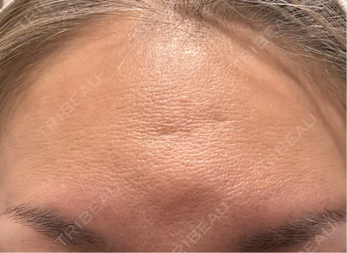 ボトックス（額） 小倉美容外科ネビュラクリニック AFTER メイン用