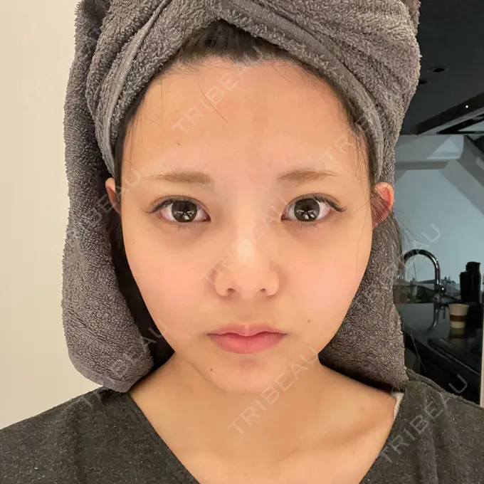 糸リフト / あご下筋肉縛り WOM CLINIC GINZA （ワム クリニック ギンザ） AFTER メイン用